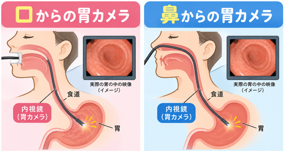 胃潰瘍・十二指腸潰瘍の症状と原因とは？
