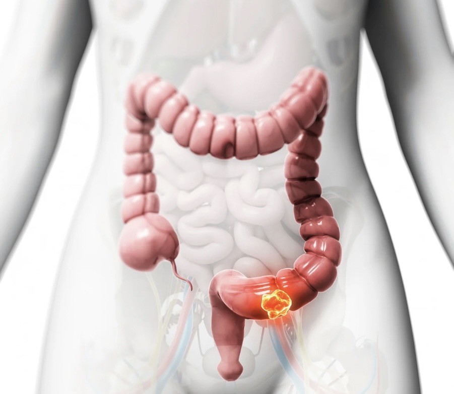 ■箕面市で大腸がん検診を受けたい方へ